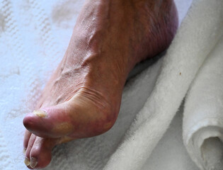 Foot of Older Male Person