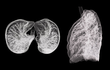 A CT chest 3D scan displaying a lesion at the right upper lobe offers a detailed visualization, aiding in precise identification and characterization of abnormalities and treatment planning. - obrazy, fototapety, plakaty