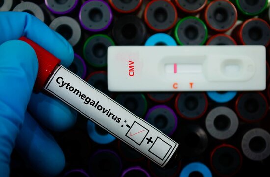 Blood sample of patient negative tested for cytomegalovirus by rapid diagnostic test.