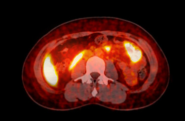 A PET-CT scan image is a diagnostic visualization combining Positron Emission Tomography (PET) and...