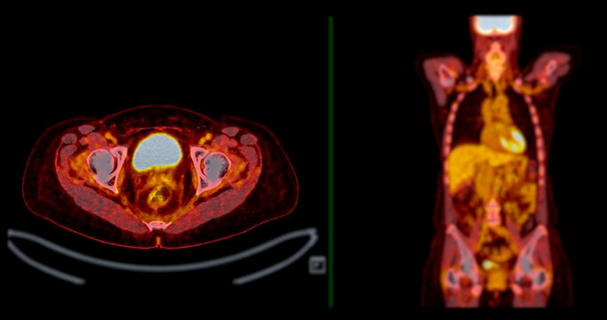 A PET-CT scan image is a diagnostic visualization combining Positron Emission Tomography (PET) and Computed Tomography (CT) for Helps in finding cancer recurrence.