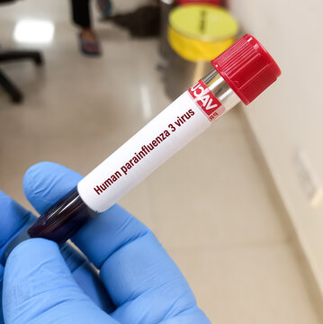 Blood sample for Human parainfluenza 3 virus (HPIV3) test.