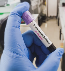 Blood sample for Growth hormone deficiency test to diagnosis Growth Hormone Deficiency,...