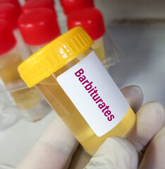 Urine sample for Barbiturate test. This test is used to measure and monitor the amount of...