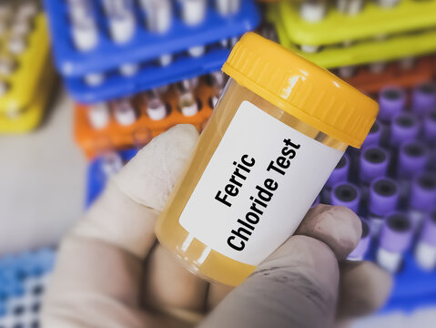 Urine sample for Ferric chloride (FeCl3) test, to determine the presence or absence of phenol.