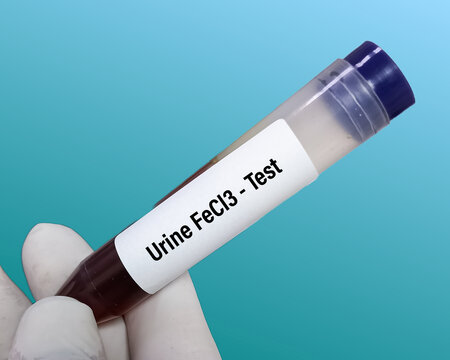 Urine sample for Ferric chloride (FeCl3) test, to determine the presence or absence of phenol.