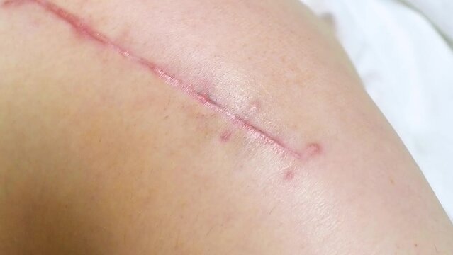 Top view of a suture on the thigh of a lying man, what the suture looks like 2 months after a total hip replacement, close up