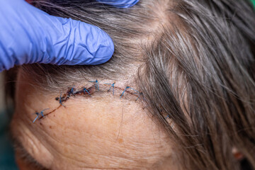 large stitched wound to the head of an elderly woman, Balance problems of elderly people, Surgical assistance, Emergency, smashed head