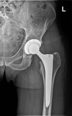 X-ray photo of left hip prosthesis of man. Total hip replacement. 6 weeks after total hip replacement