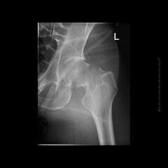 Left transcervical neck fracture. Femoral neck fracture. Joint closeup. X-ray photo of man....