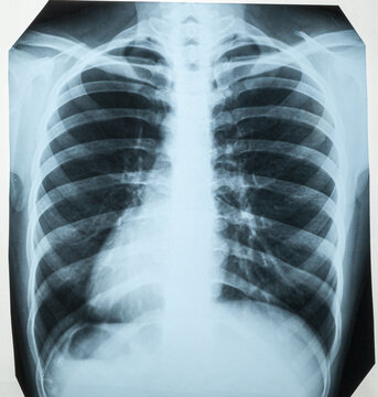 Chest x-ray photo of woman, with lungs, thoracic spine and thoracic cage