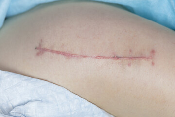 Top view of a suture on the thigh of a lying man, what the suture looks like 2 months after a total...