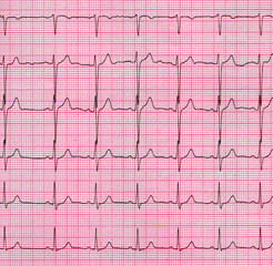 A fragment of a cardiogram. Cardiological examination