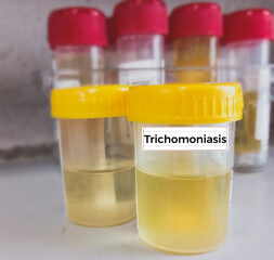 Urine sample for Trichomoniasis test, is a very common STD caused by infection with Trichomonas vaginalis.