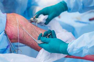 Surgeon use laparoscopic instrument for leg patient minimally invasive surgery. Suturing tendons and ligaments in knee of man, operating hospital - obrazy, fototapety, plakaty