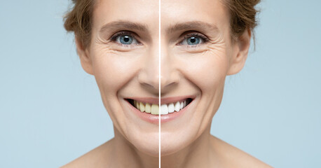 Collage of female smile before and after teeth whitening. Advertising procedure whitening smile