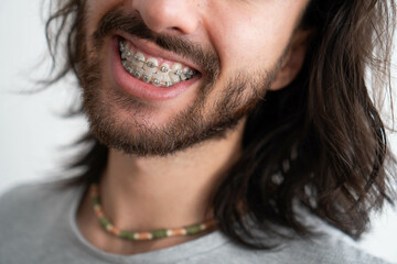 close up of teeth with braces on a young bearded man