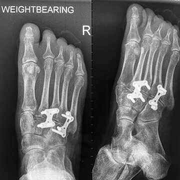 X ray of a foot that has had metal screws and plates inserted