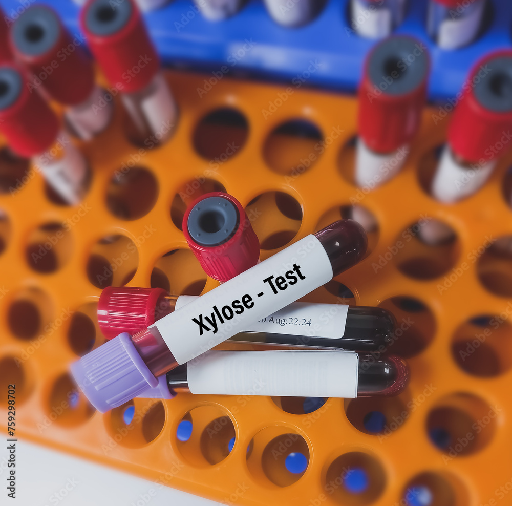 Sticker blood sample for xylose test, to help diagnose malabsorption disorders, that affect your ability to 