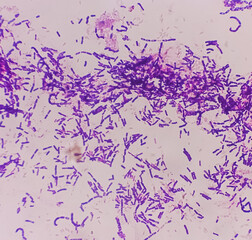 Yeast Infection; Budding yeast and pseudohyphae of Candida albicans, gram's stain. This fungus...