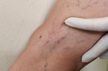 close up of a massage, showing the wrinkle and spider, varicose veins on the body, problem...