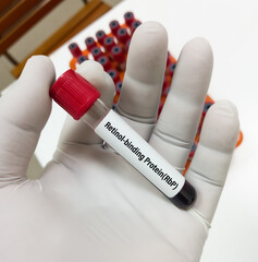 Blood sample for Retinol Binding Protein (RbP) testing which is used to assess renal tubular injury...