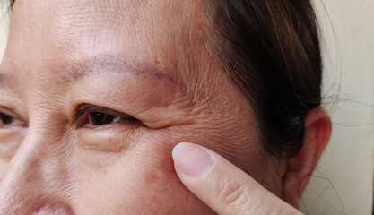 close up of a person pointing the wrinkle and Flabby skin beside the eyelid, ptosis and loose, dark spots and blemish on the face of the woman, health care and beauty concept.