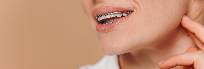 Obraz premium Close-up of a woman with braces on a beige background