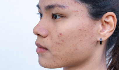 An Asian teenage girl with uneven facial skin problems. The invasion of acne, inflamed acne,...
