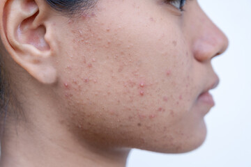 An Asian teenage girl with uneven facial skin problems. The invasion of acne, inflamed acne,...