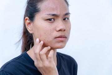 An Asian teenage girl with uneven facial skin problems. The invasion of acne, inflamed acne,...