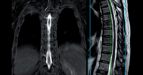 Fototapeta na wymiar MRI T-L spine or Thoracosacral spine Axial and sagittal T2 technique with reference line for diagnosis spinal cord compression.
