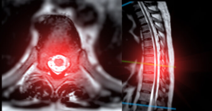 MRI T-L spine or Thoracosacral spine Axial and sagittal T2 technique with reference line  for diagnosis spinal cord compression.