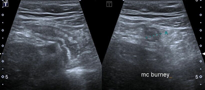  ultrasonography of apendicitis
