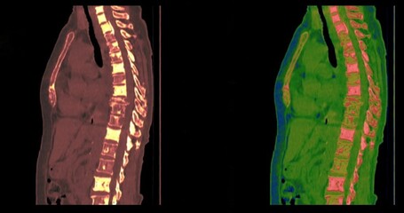 bone metastasis , sagital  chest CT scan  images 