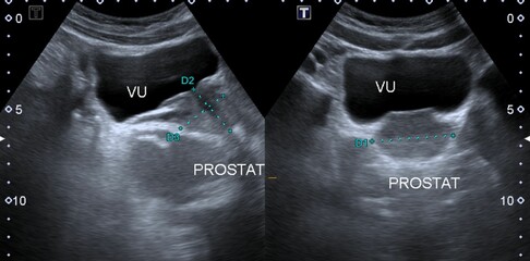  ultrasonography normal prostate
