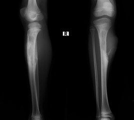 Bone cancer of the tibia , X-ray
