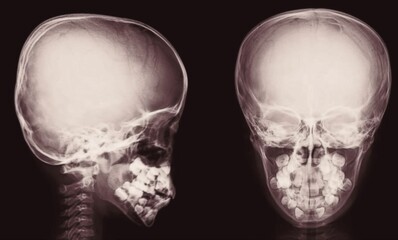 normal skull x ray  anterior and lateral view 
