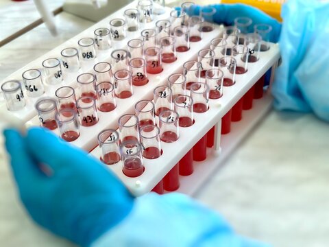 Many test tubes with patient's blood for analysis.