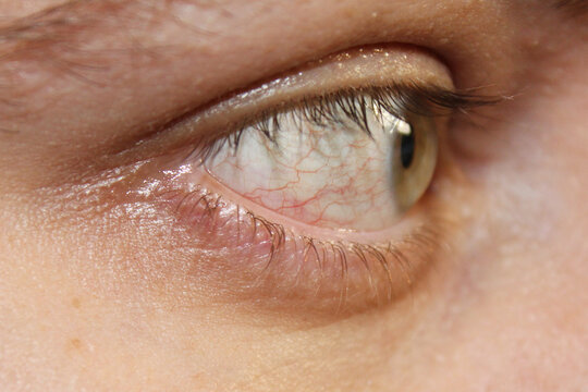 Tired green eye with red capillaries. The concept of long-term work at the computer and vision treatment. White of the eye with red veins. Stock photos of ophthalmology in the best quality.