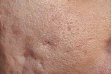 Problem skin with acne marks. Stock human skin texture in the best quality. Photo with scars.