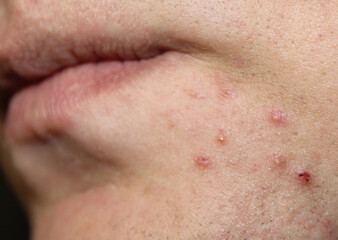 Problem skin with acne on the body. Stock human skin texture in the best quality. Photo with scars.