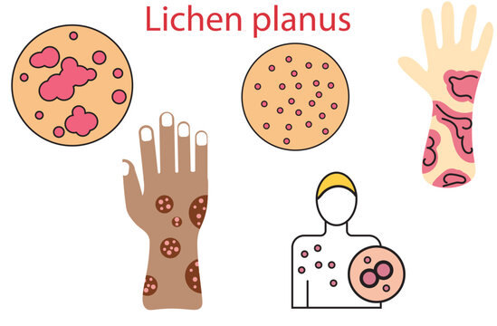 Lichen planus,non-infectious, itchy rash that can affect many areas of the body,skin illustration,arms, legs and trunk,fungus,Skin Problem,five vectors