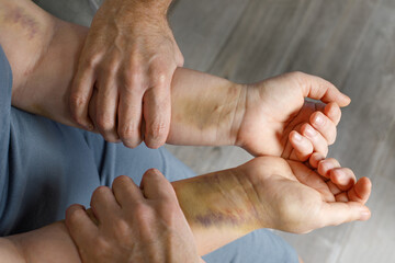 Male hand and female hand with bruise. Domestic violence and abuse concept.