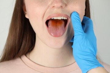 Gastroenterologist examining patient with yellow tongue on light grey background, closeup