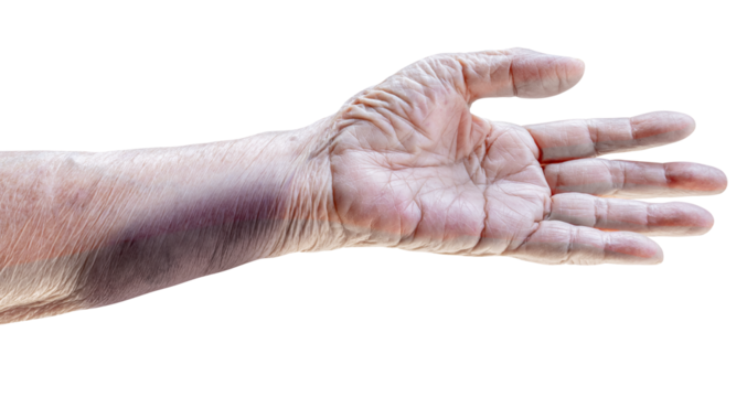 Arm of elderly woman has bruises