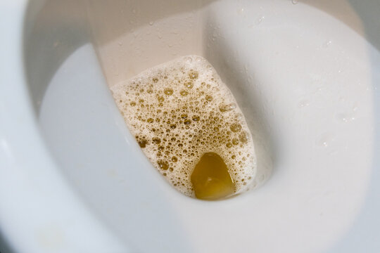 Closeup on yellowish urine with bubble in toilet bowl may indicate health problem