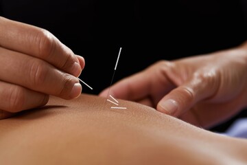 Relaxing Acupuncture treatment back. Chinese healthy. Generate Ai
