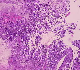 Kidney cancer: Microscopic image of metastatic clear cell carcinoma of kidney, the most common type of renal cell carcinoma. Show brain tissue of malignant neoplasm, large atypical bizarre cells.