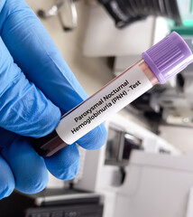 Blood sample for Paroxysmal nocturnal hemoglobinuria (PNH) disease test. HAM'S Test.